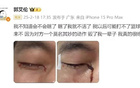 郭艾倫訓(xùn)練傷眼，責(zé)任方需擔(dān)法責(zé)